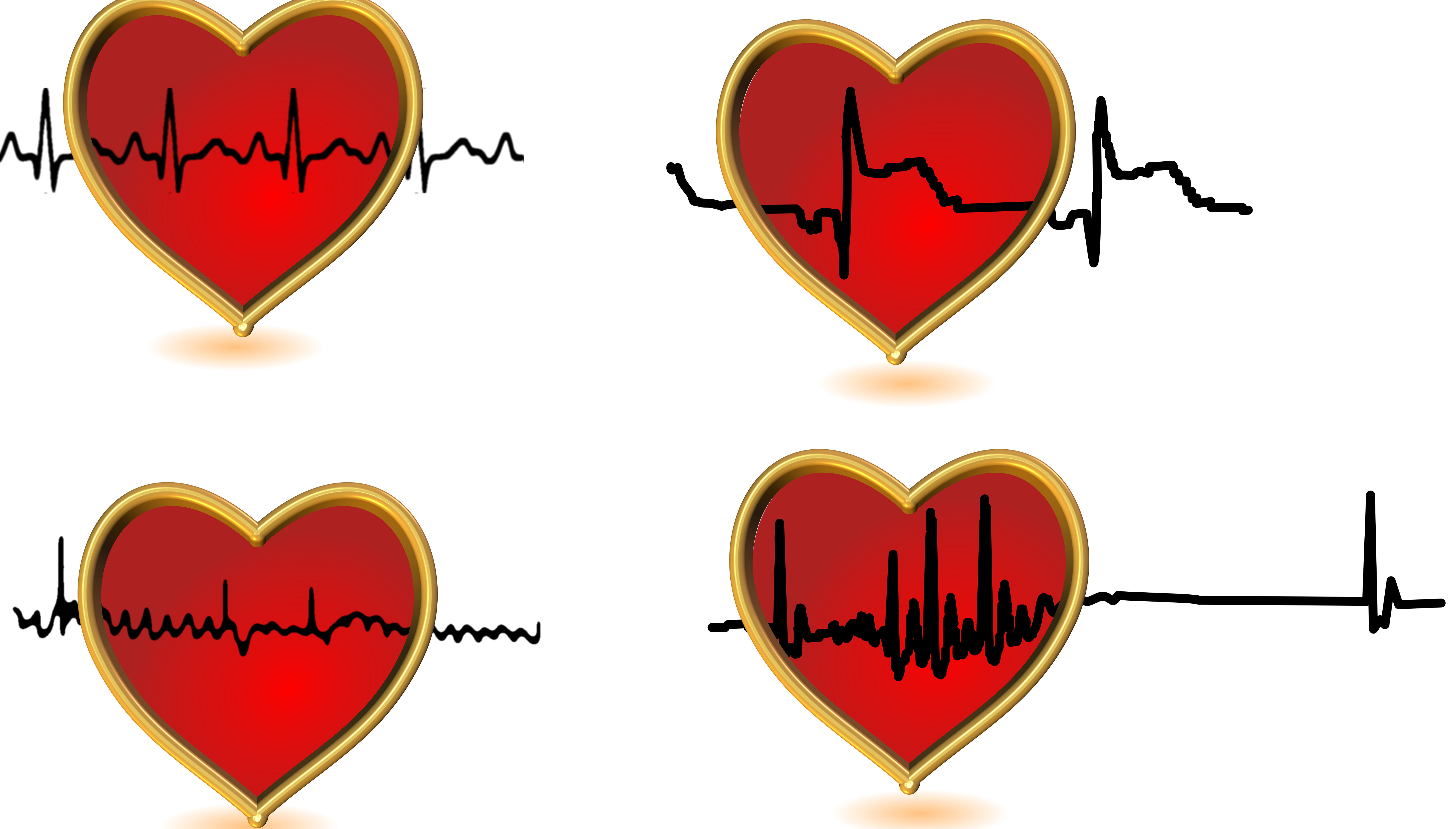 Holter EKG